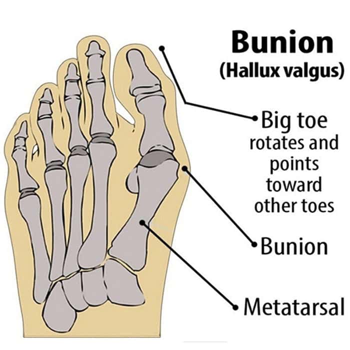Bunion Corrector_Toe Corrector_Toe Straightener_Efforest_Image