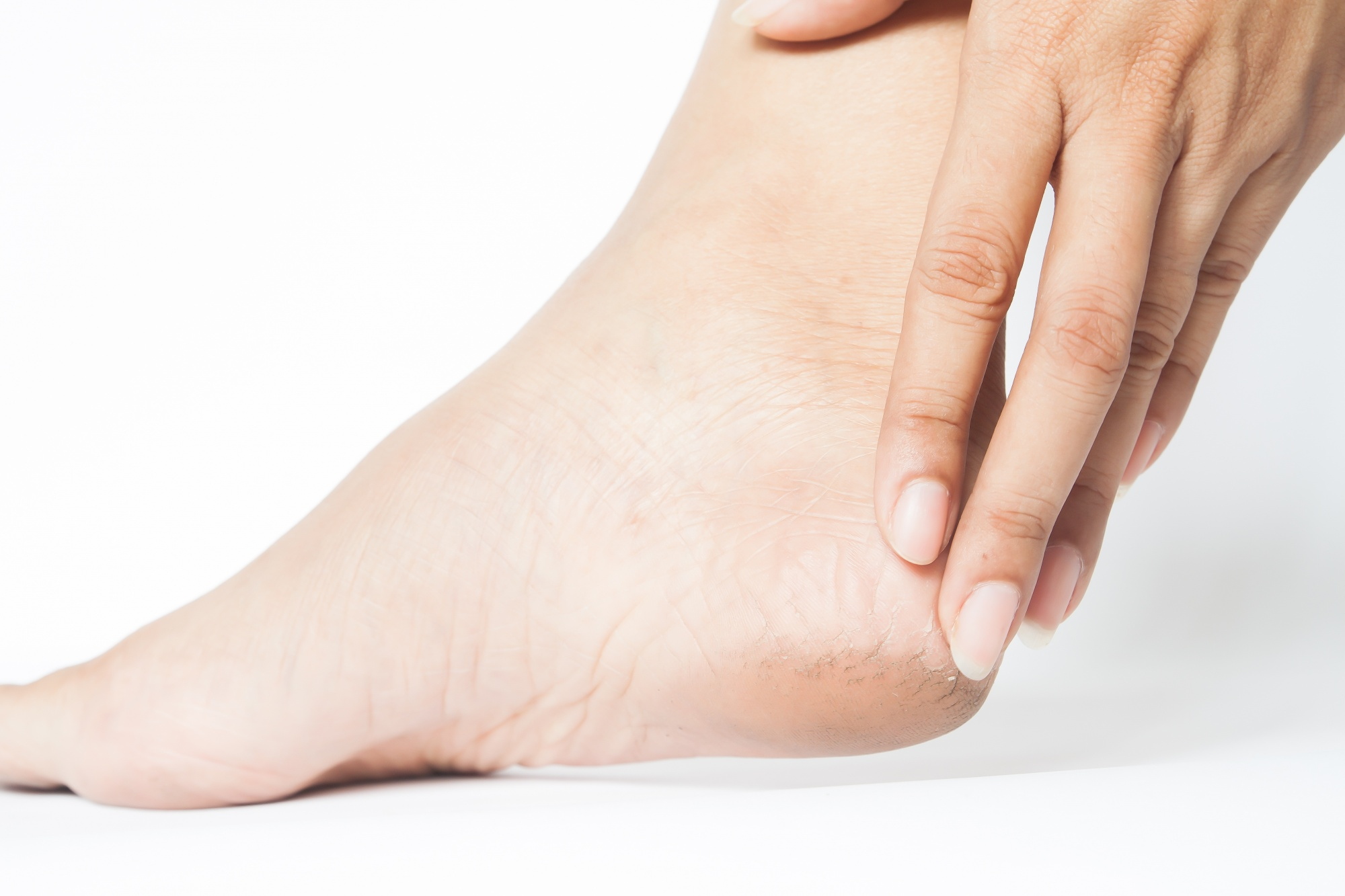 How to Get Rid of Calluses on Feet: Your Ultimate Guide